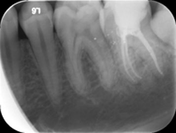 Root Canal x-ray in pleasant grove, utah county
