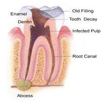 Toothache and Root Canal / endondontics in Pleasant Grove, Utah county