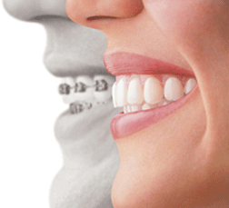 Clear Ceramic  Orthodontist in Utah County, UT